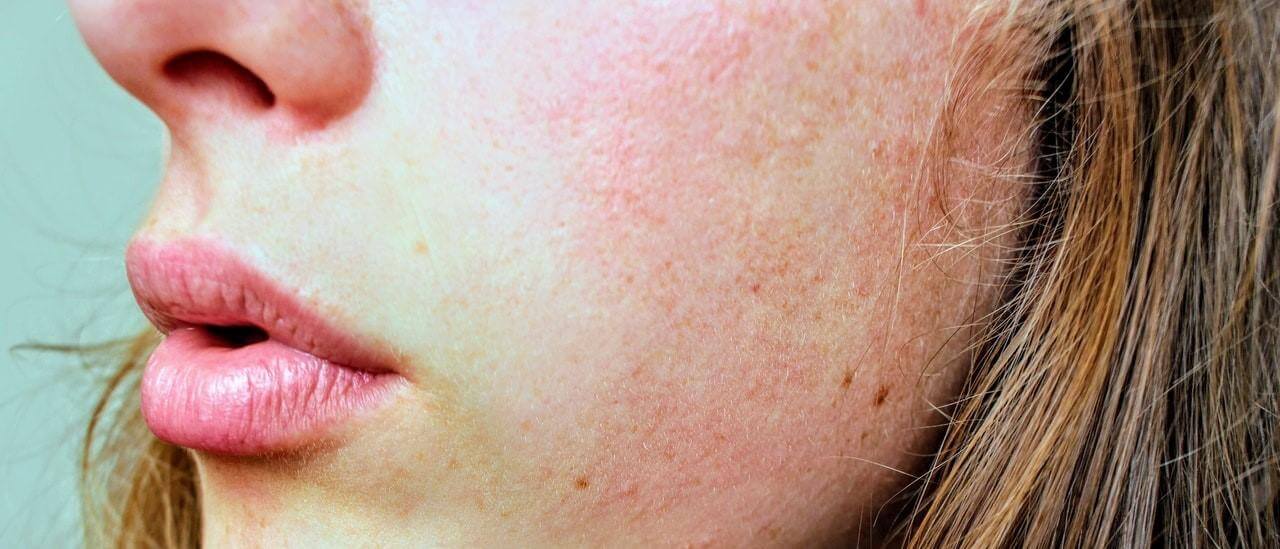 salicylic acid - what is it and how to use it