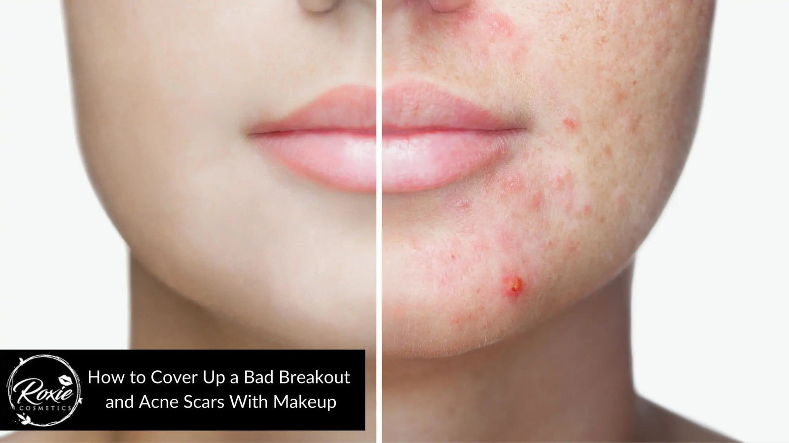 How to Cover Up a Bad Breakout and Acne Scars With Makeup
