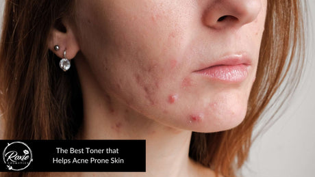 Best Toner for Acne Prone Skin